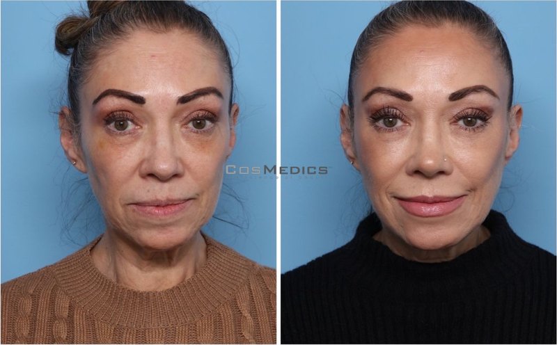 CosMedics patient before and after result