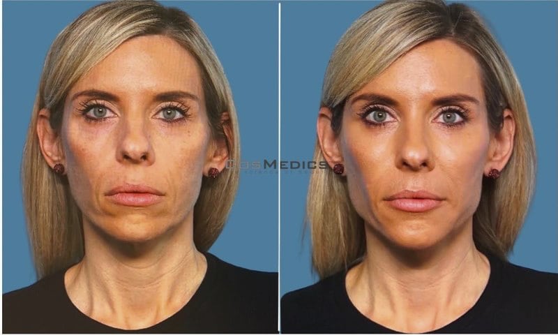 CosMedics patient before and after result