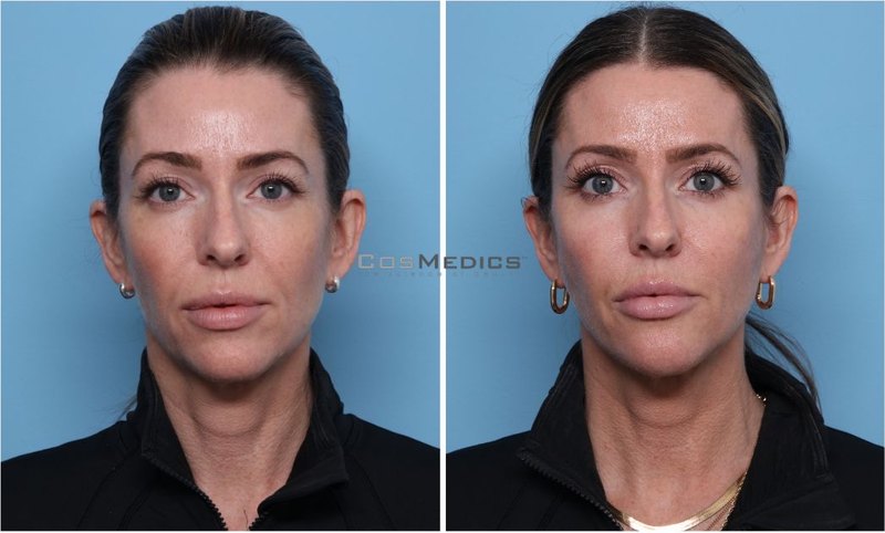 CosMedics patient before and after result