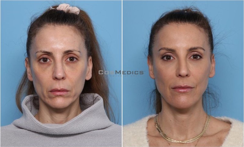 CosMedics patient before and after result