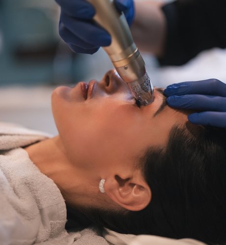 Fractional skin resurfacing laser treatment in progress
