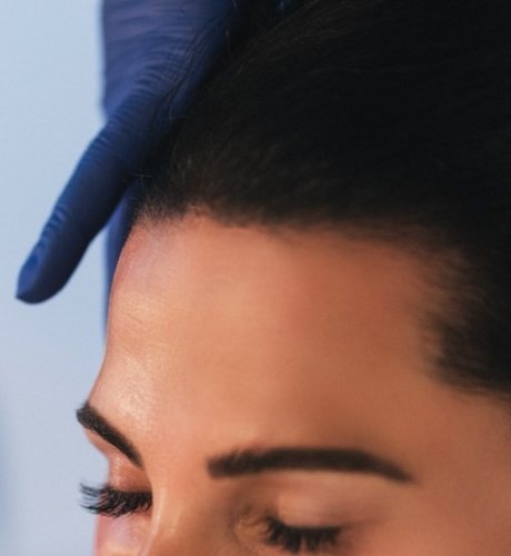 PRP scalp treatment for thinning hair