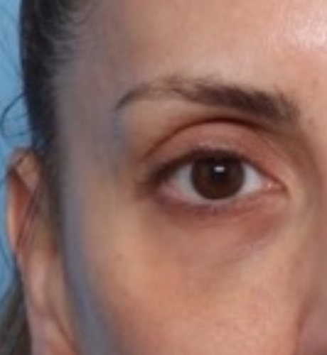 Under-eye area showing bags and dark circles