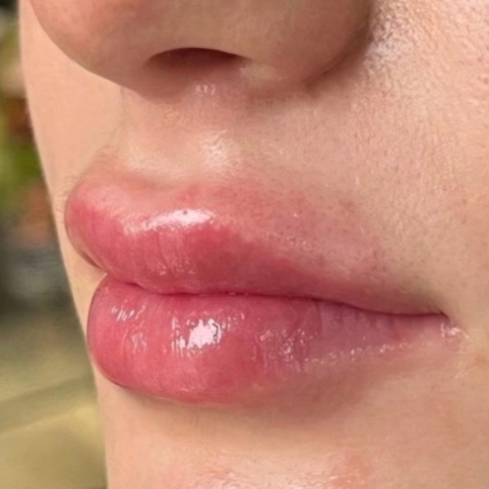 Lip Fillers