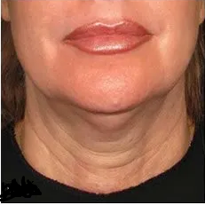 Neck & Jawline Lift