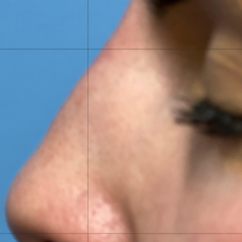Non-surgical nose job (nose contouring)