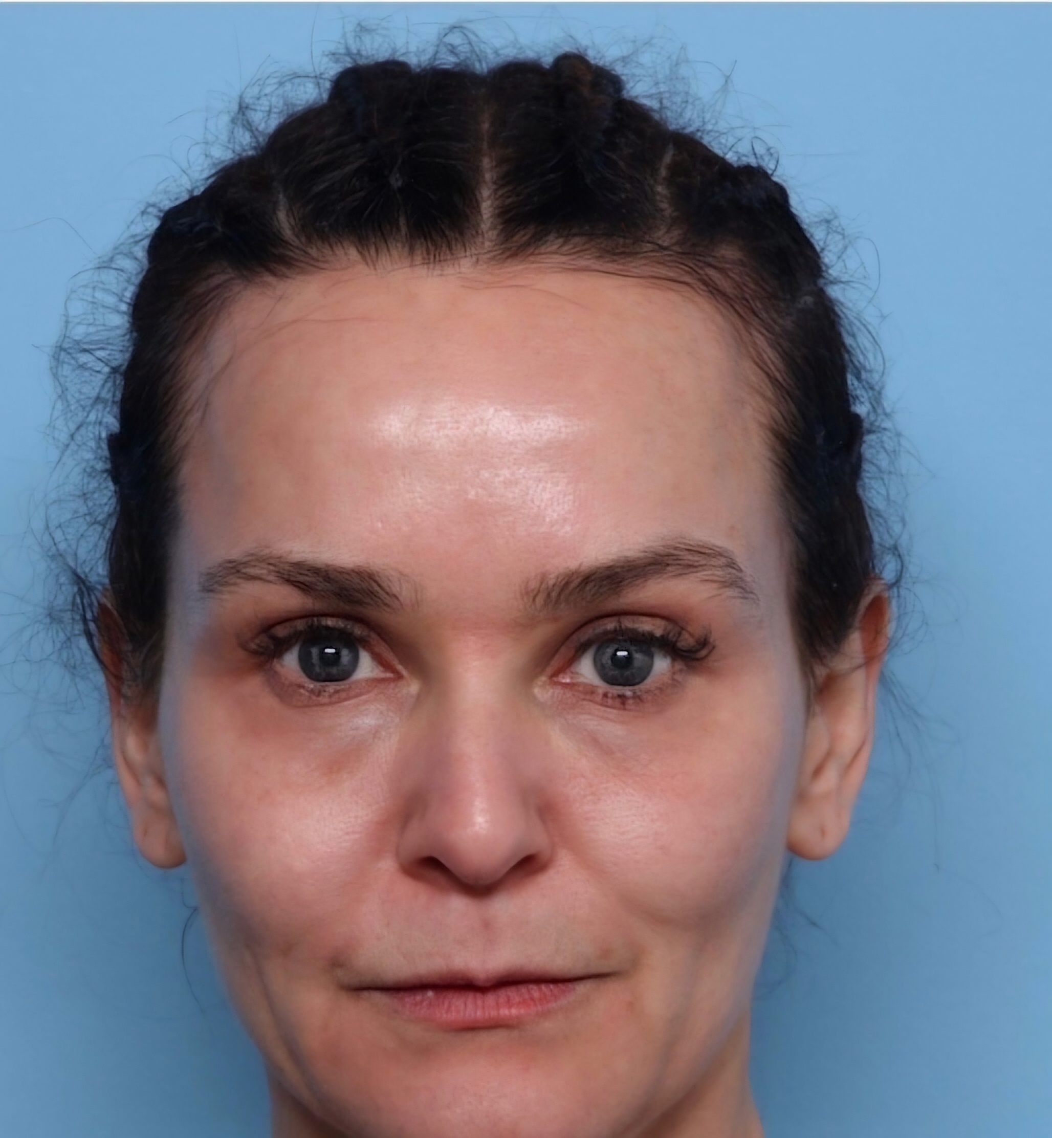 PRP Treatment (Vampire Facial/Vampire Lift)