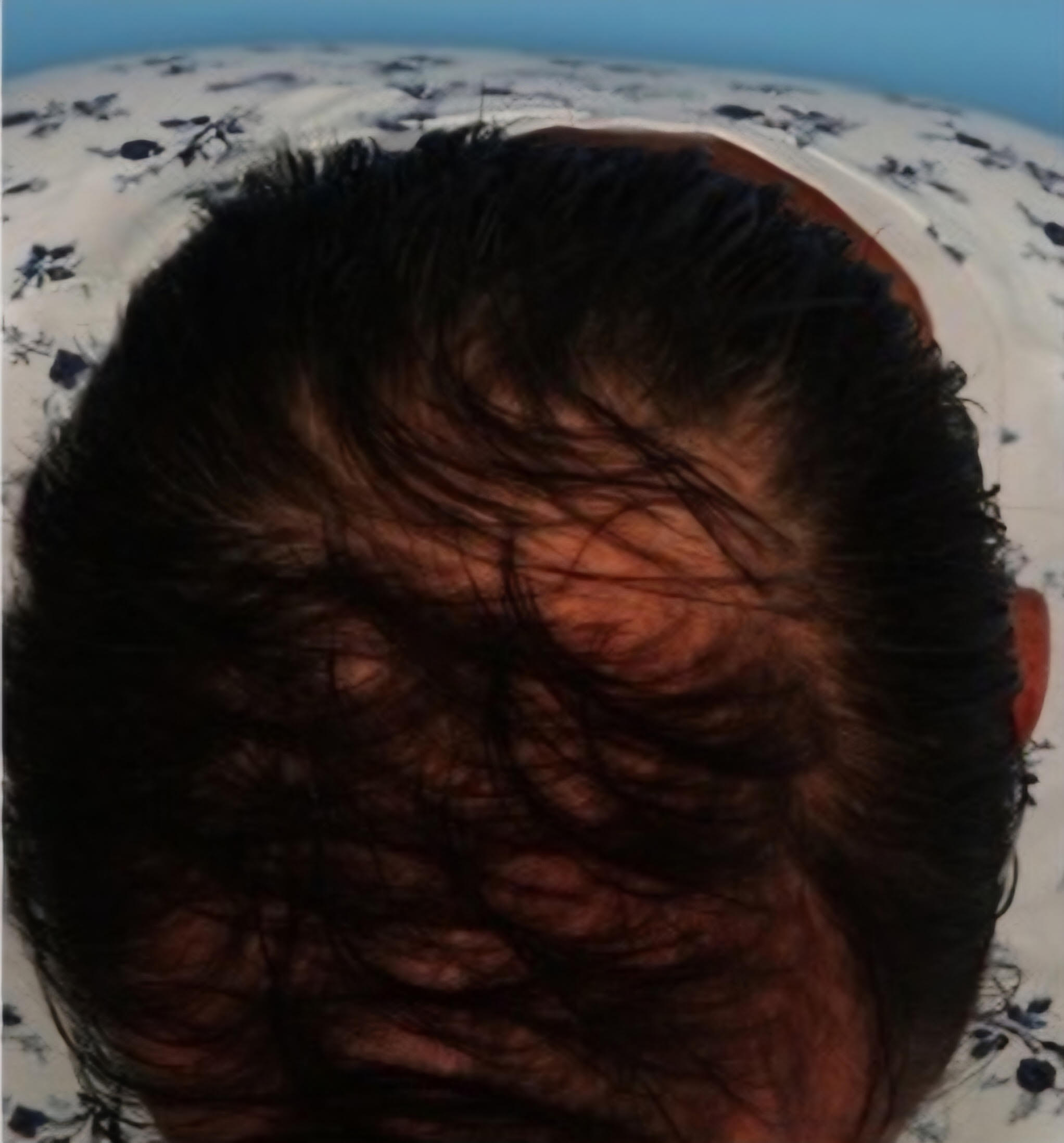PRP (Platelet-Rich Plasma) for Thinning Hair