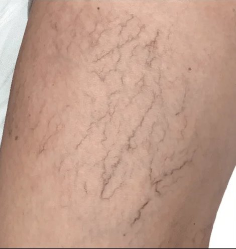Sclerotherapy