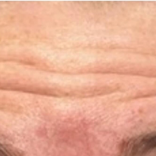 Wrinkle Reduction